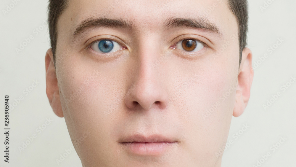 Young man with heterochromia - two different colored eyes. Contact  lenses.face close-up Stock Photo | Adobe Stock