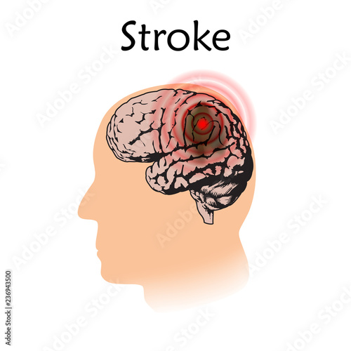 Stoke poster, banner. Vector medical illustration. White background, pink silhouette of man head, anatomy flat image of damaged human brain.