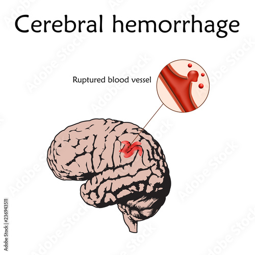 Cerebral hemorrhage poster, banner. Vector medical illustration. white background, anatomy flat image of damaged human brain, ruptured blood vessel.