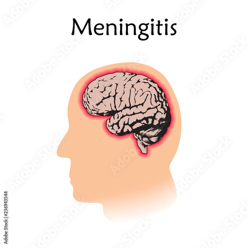 Meningitis. Vector medical illustration. White background, silhouette of head, anatomy flat image of brain.