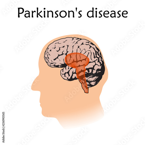 Parkinson's disease poster, banner. Vector medical illustration. White background, pink silhouette of old man head, anatomy flat image of damaged human brain.