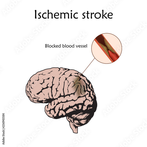 Ischemic Stoke poster, banner. Vector medical illustration. white background, anatomy flat image of damaged human brain, blocked blood vessel.