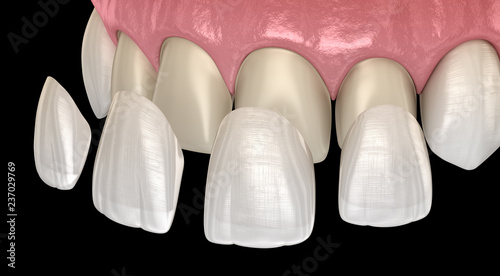 Fototapeta Naklejka Na Ścianę i Meble -  Veneer installation procedure over central incisor and lateral incisor. Medically accurate tooth 3D illustration