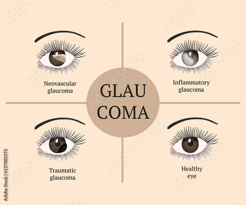 Eye disease. Ophthalmology health illustration.