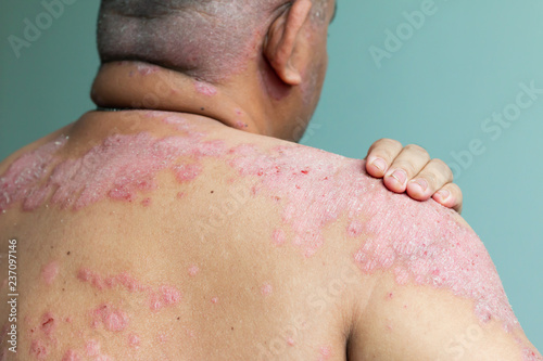 Patient is holding shoulder wound