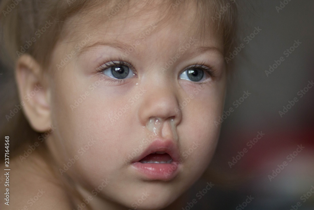 child with runny nose child with runny nose
