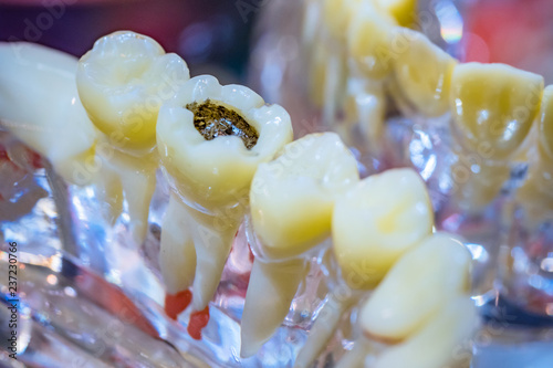 An example of dental diseas...