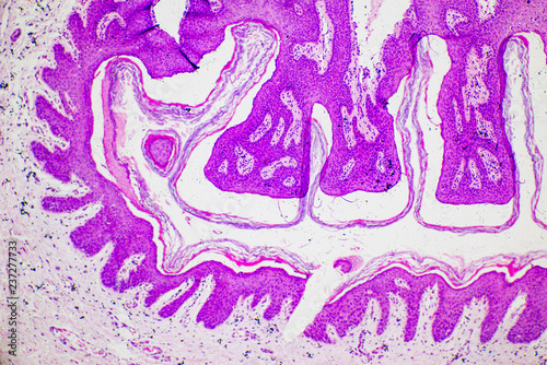 Skin papilloma of human micrograph. photo