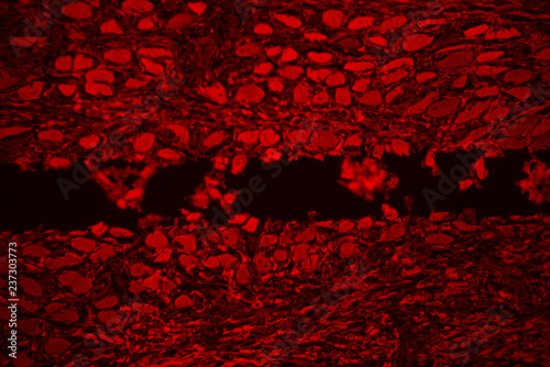 Eosinophilic granuloma of human photo
