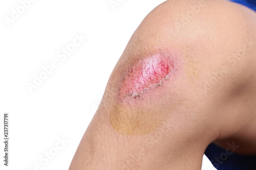 Asian boy got accident painful wound, scraped or injured on knee in football game. Close up of bleeding scraped after run accident isolated on white background.