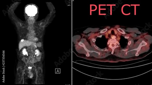 Positron emission tomography (PET) of  human whole body  Coronal and cross Axial view or cross section view. photo