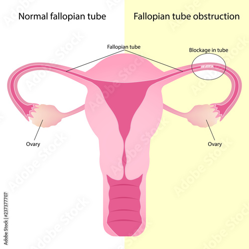 Comparison between normal fallopian tube and fallopian tube obstruction, Uterus and uterine tubes.
