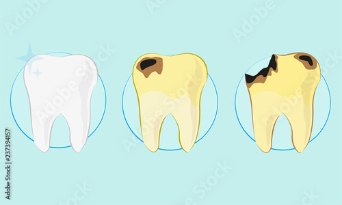Kind of teeth, clean, caries vector illustration, flat style