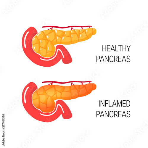 Inflames pancreas concept. Vector illustration