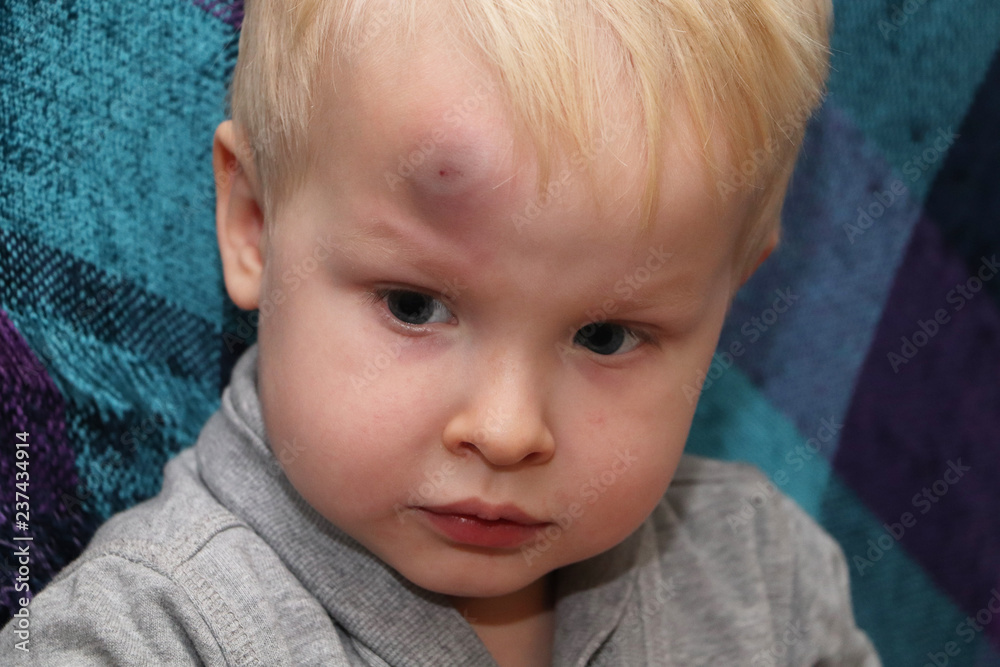 A big bruise on the forehead of a little boy A big bruise on the forehead of a little boy