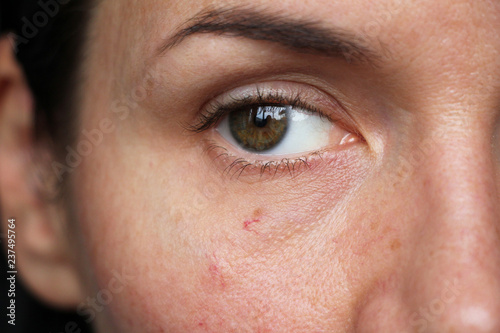 capillaries on the skin of the face, photo