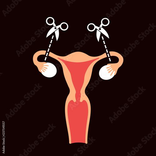 Tubal ligation and tubectomy - reproductive female and woman organ after  sterilization and sterilisation. Permanent contraception and birth control.  Vector illustration Stock Vector | Adobe Stock