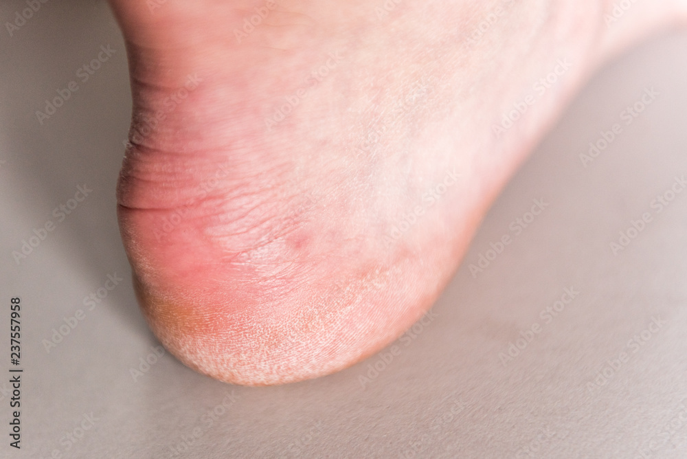Dry woman heels with rough skin on gray background. Callus on foot. Dry woman heels with rough skin on gray background. Callus on foot.