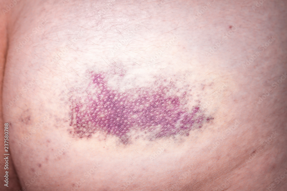 close up of bruise hit on the leg, hematoma