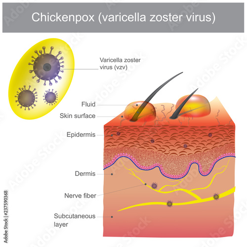 Chickenpox varicella zoster virus.