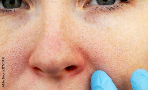 Cuperosis on the nose of a young woman. Acne on the face. Examination by a doctor