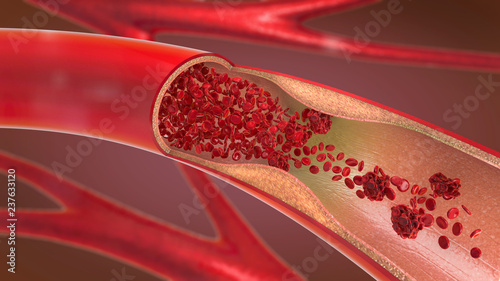 3d illustration of a constricted and narrowed artery and the blood cannot flow properly called arteriosclerosis