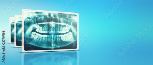 Woman x-ray of the teeth wisdom teeth horizontal pozition problem dentistry medicine. Panoramic image of teeth