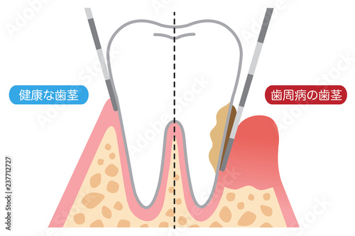 歯周病の歯茎と健康な歯茎