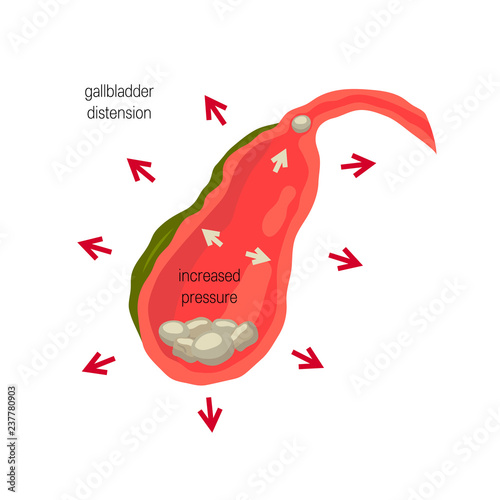 Inflamed gallbladder, cholelithiasis concept