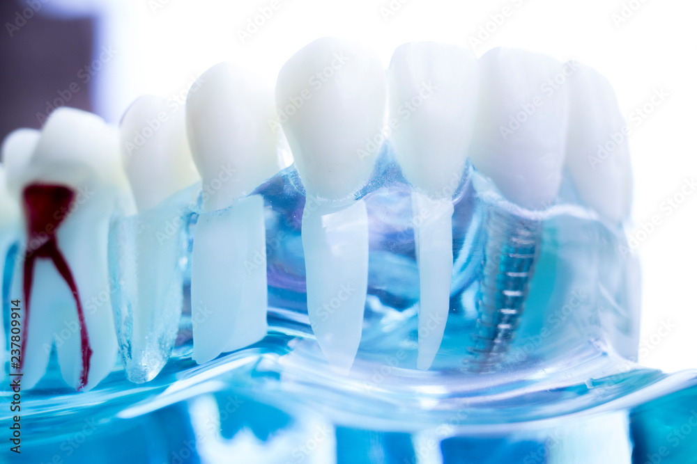 Dentist dental teeth implant Dentist dental teeth implant