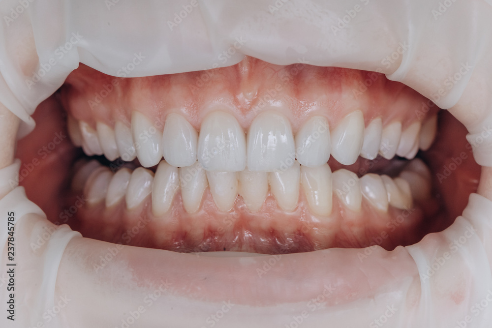 Finished ceramic front crowns. 8 units dental veneers. Finished ceramic front crowns. 8 units dental veneers.