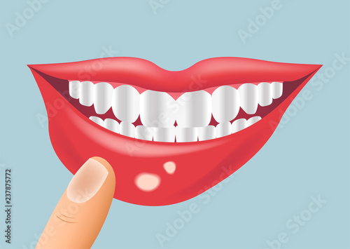 mouth aphtha vector / aphthous