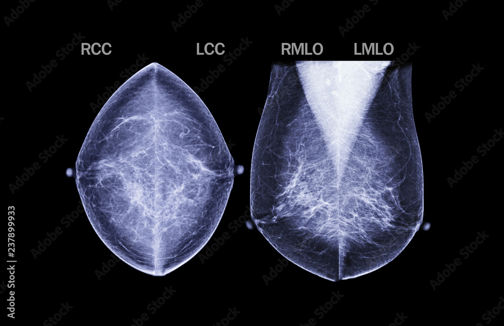 Basic position Xray Digital Mammogram both side name is CC view and