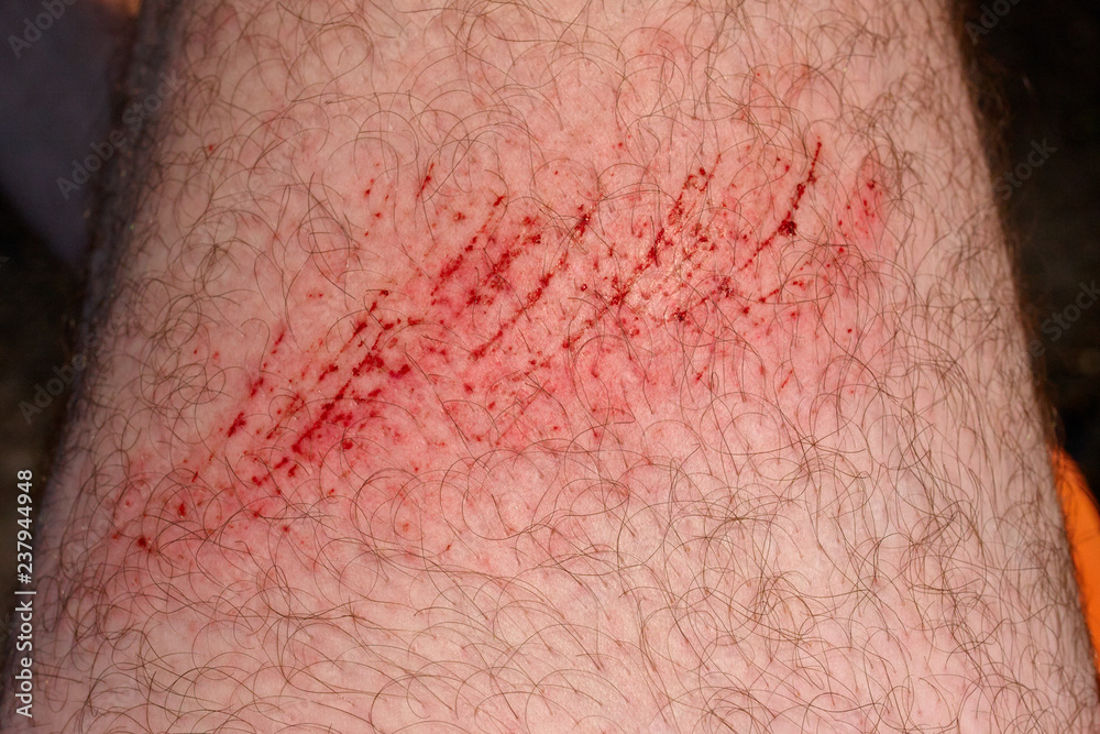 Cut On Skin