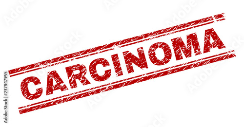 CARCINOMA seal stamp with corroded texture. Red vector rubber print of CARCINOMA caption with corroded texture. Text tag is placed between double parallel lines.