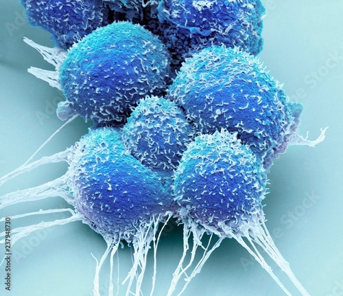 Close up of prostate cancer cells