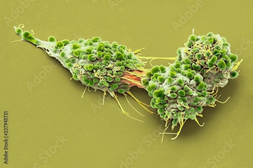 Close up of ovarian cancer cells
