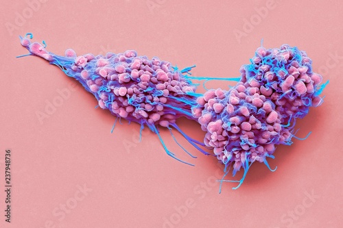 Close up of ovarian cancer cells