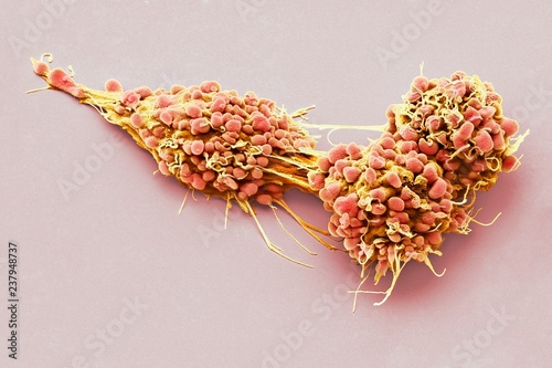 Close up of ovarian cancer cells photo