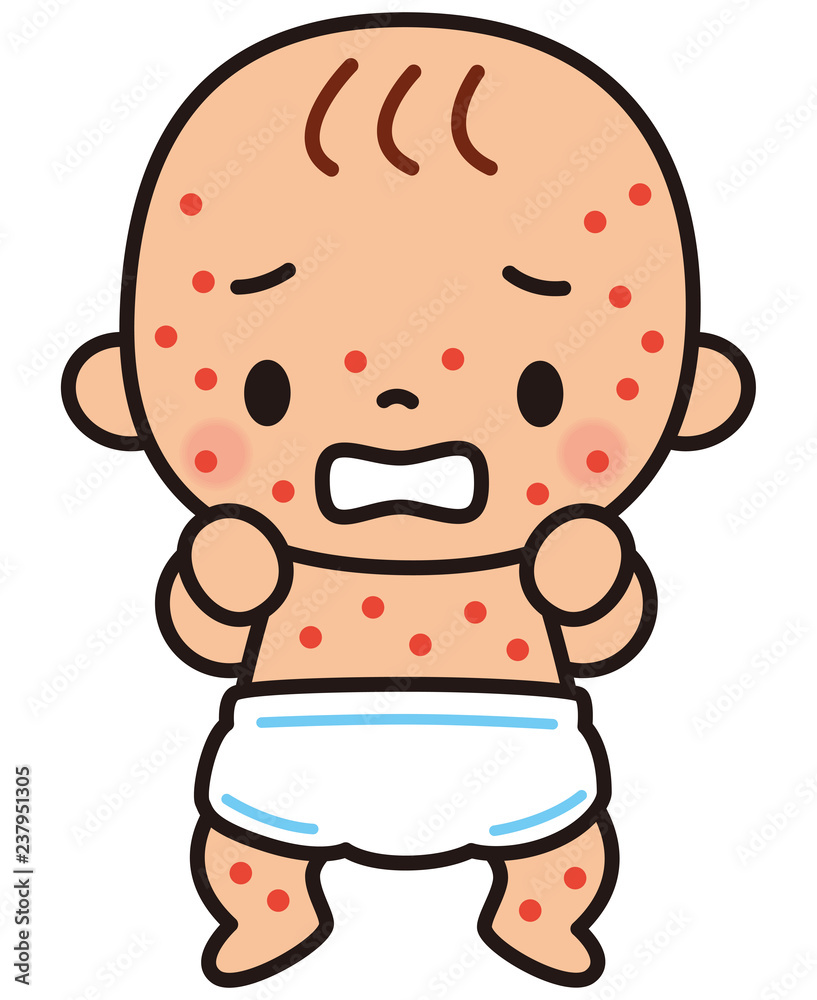 4 Best 小児バラ疹 Images Stock Photos Vectors Adobe Stock