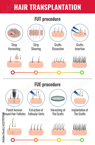 Hair Transplantation Infographics