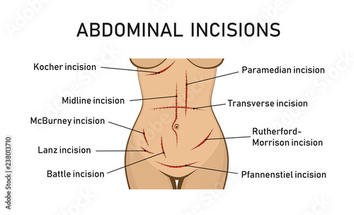 Abdominal incisions. Surgery. Vector illustration