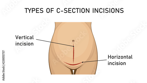 Types of incisions in cesarean delivery