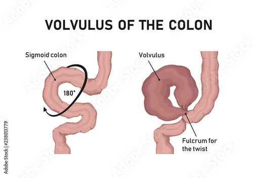 volvulus of the colon