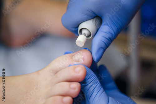 Podology treatment. Podiatrist treating toenail fungus. Doctor removes calluses  corns and treats ingrown nail. Hardware manicure. Health  body care concept. Selective focus.