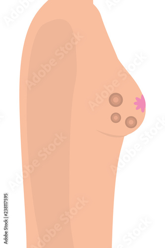 Breast cancer sign