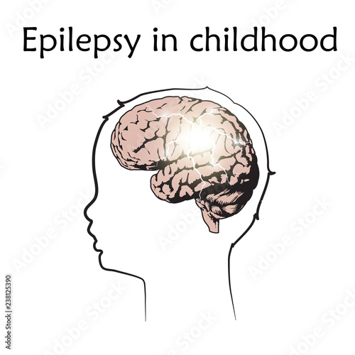 Epilepsy in infants, childhood. Vector medical illustration. Kid, baby, childhood. White background, line silhouette of child head, anatomy flat image of brain, electrical discharge.