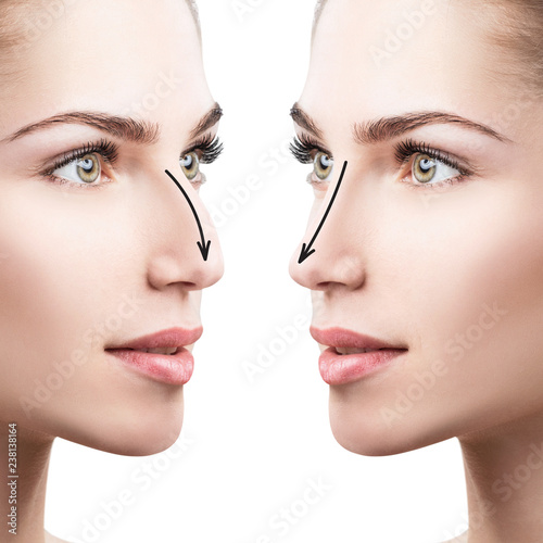 Female nose before and after cosmetic surgery. photo