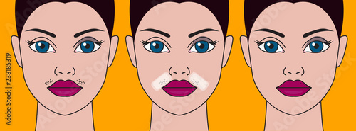Girls mustache, cosmetic defect