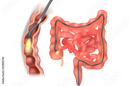 Illustration of colonoscope in the colon during a colonoscopy procedure. GI Endoscopy  photo